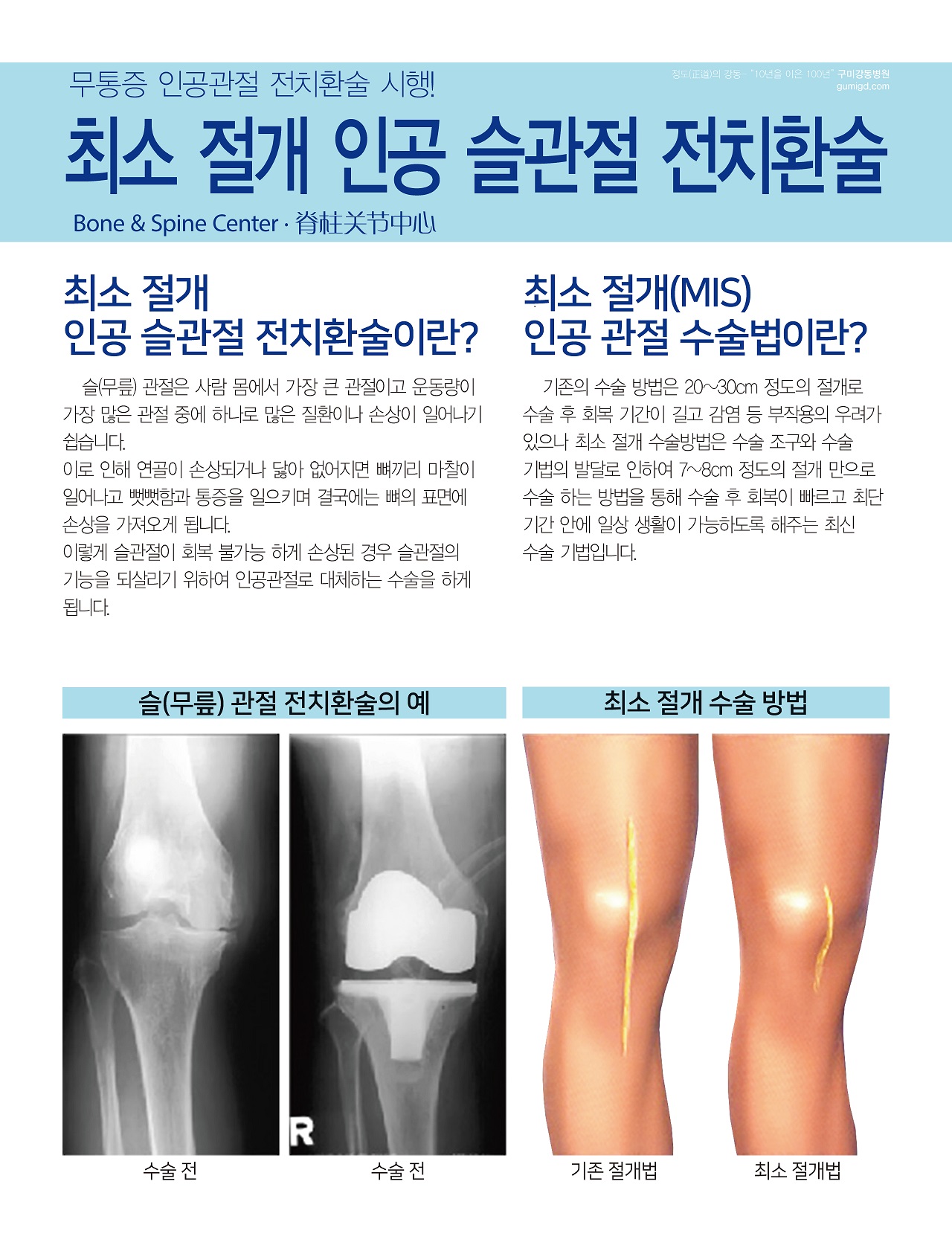 무통증 인공 슬관절 전치환술 첨부 이미지