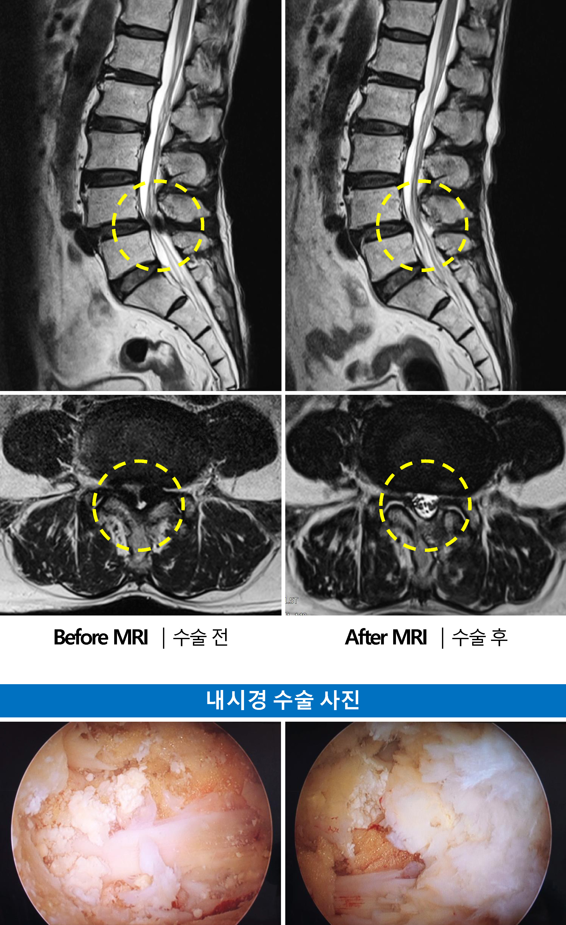 양방향 내시경 ULBD (‘척추관 협착증’ 수술에 있어 과거보다 매우 안전) 첨부 이미지
