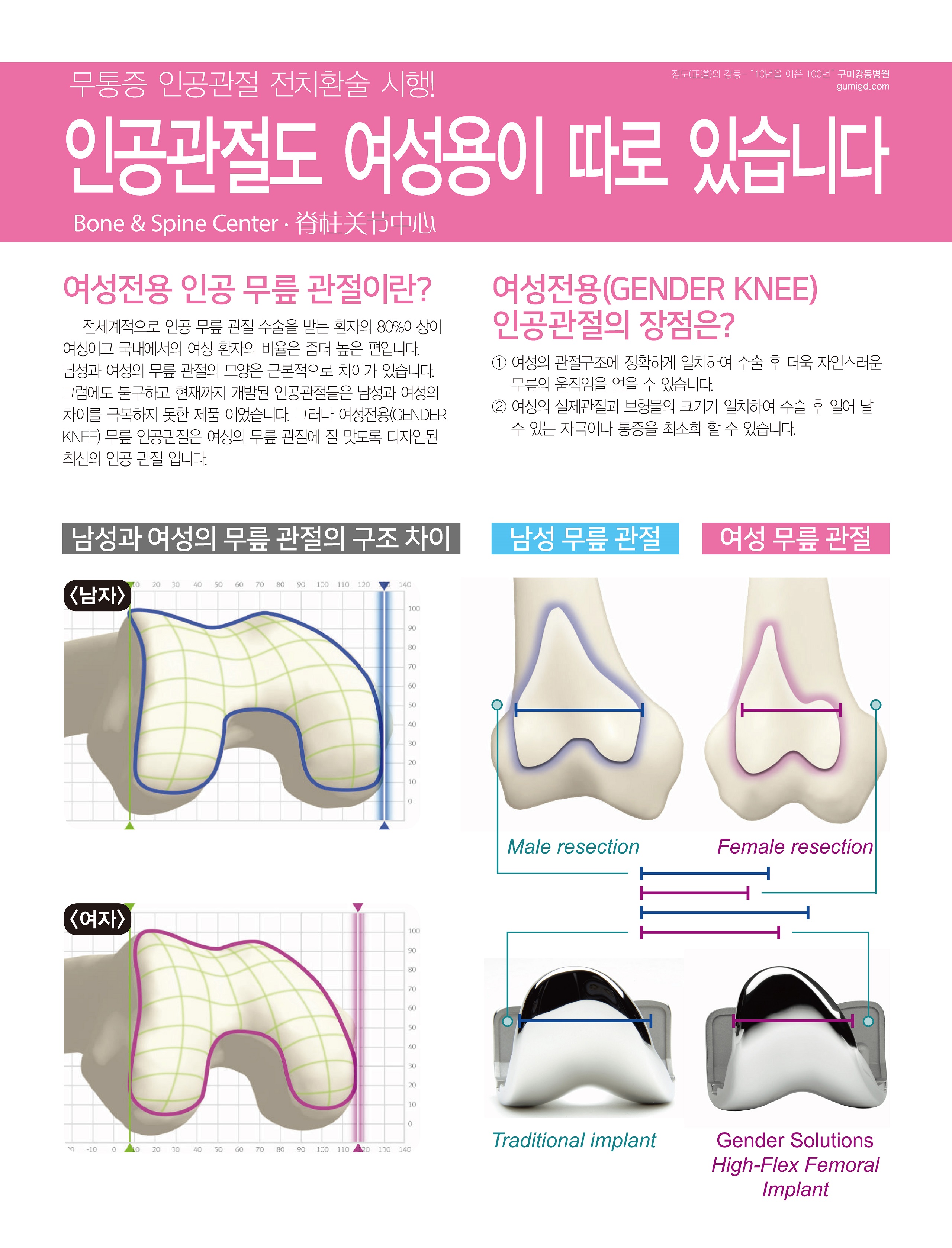 여성용 인공관절 - 인공관절도 여성용이 따로 있습니다 첨부 이미지