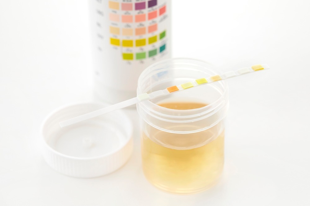 소변검사 (Urinalysis) 첨부 이미지