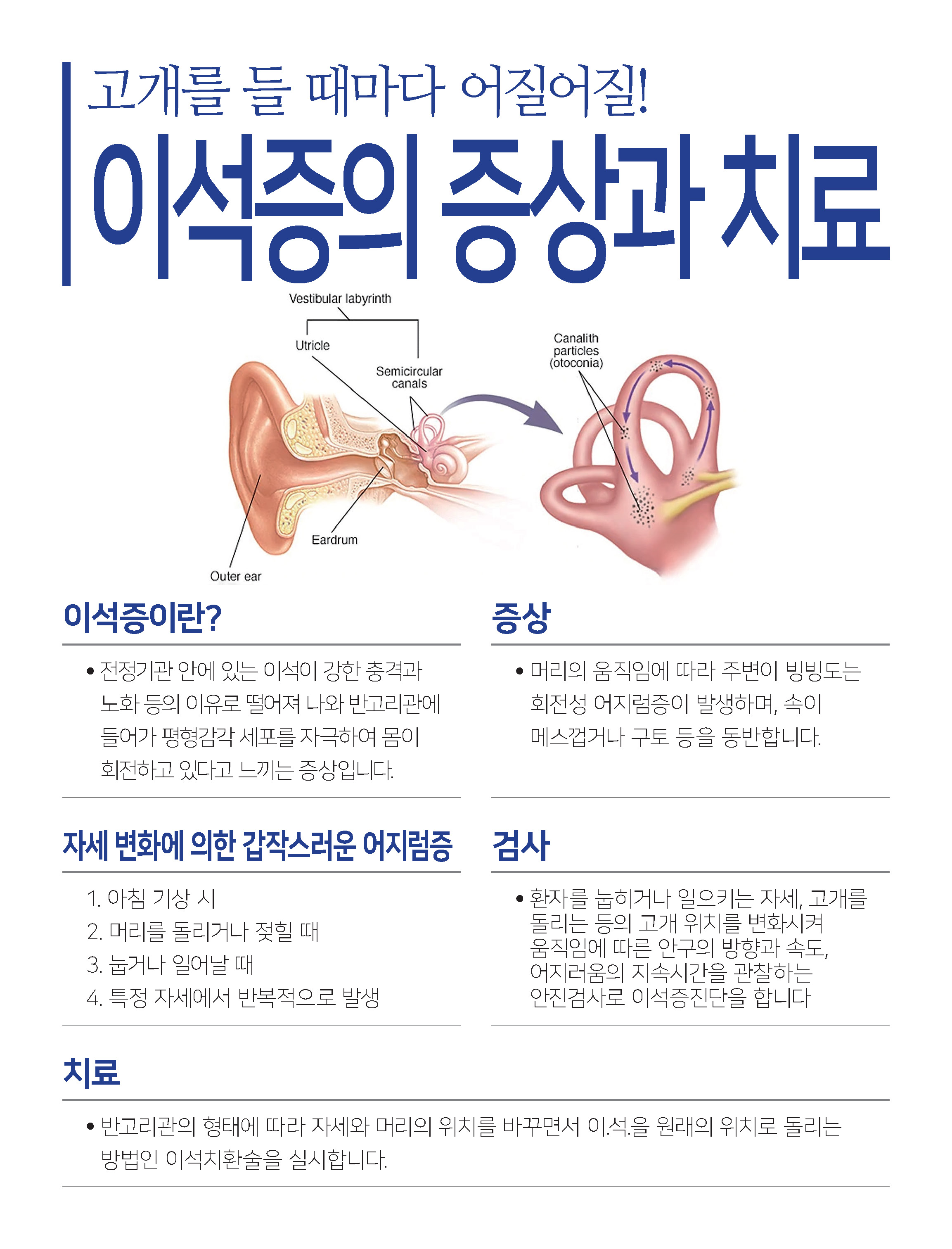 갑작스런 어지럼 [이석증 : 耳石症] 골다공증 있는 여성 주의 첨부 이미지