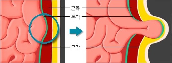 서혜부 탈장 : hernia, 脫腸 첨부 이미지