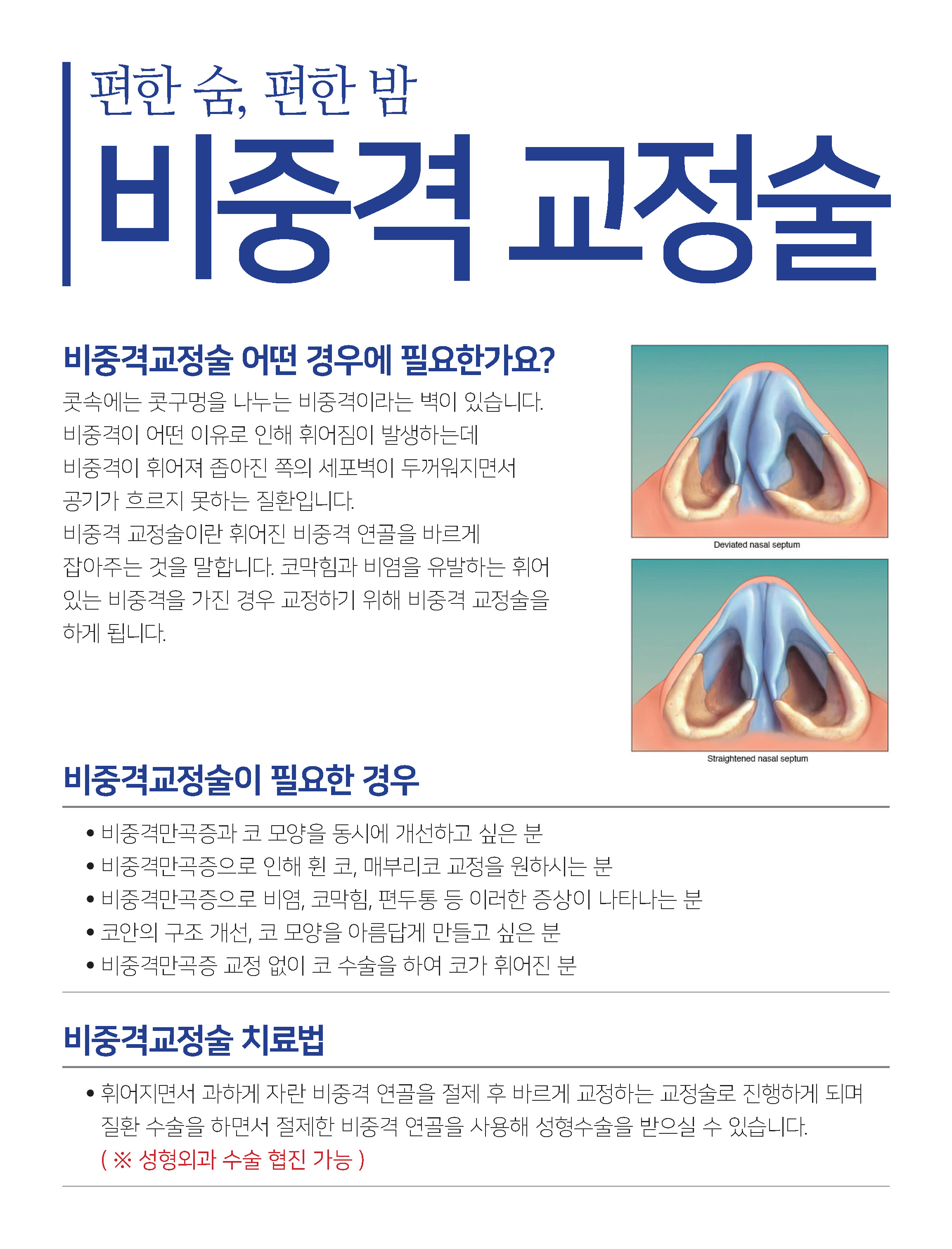 비중격 교정술 : Nasal septoplasty 첨부 이미지