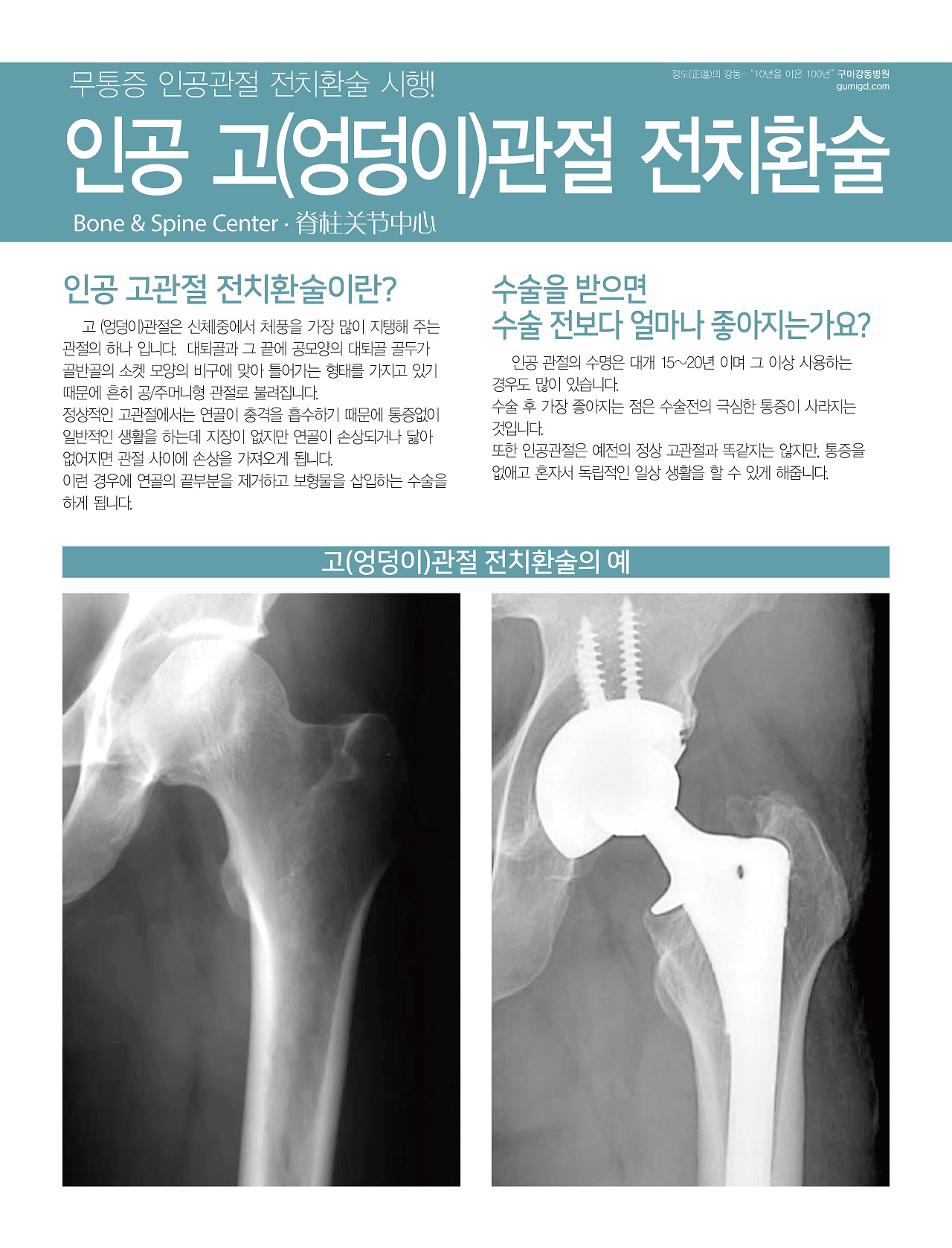 무통증 인공 고(엉덩이)관절 전치환술 첨부 이미지