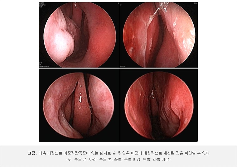 비중격 교정술 : Nasal septoplasty 첨부 이미지